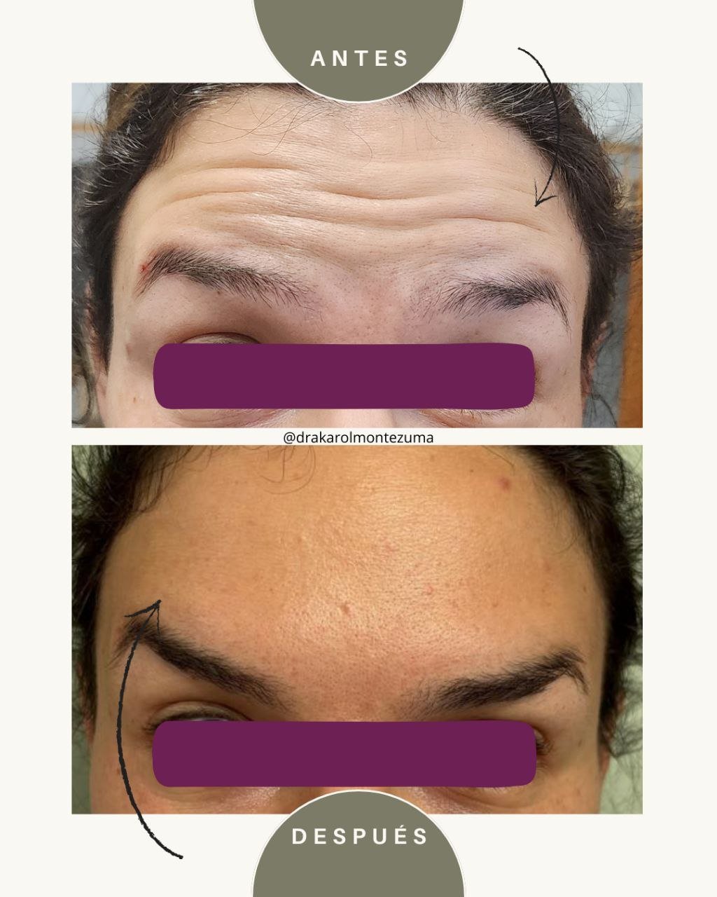 Toxina Botulínica
