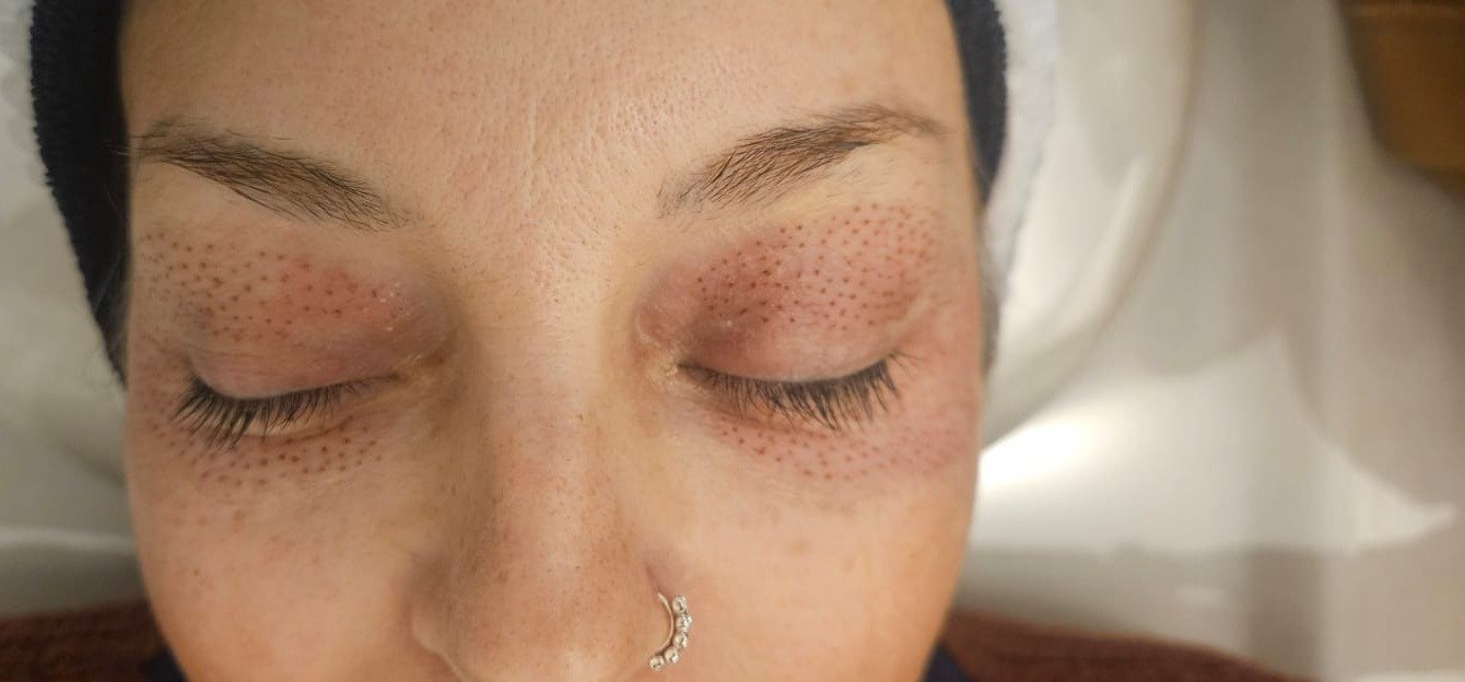 Micropuntos de plasma recién aplicados en el contorno de ojos