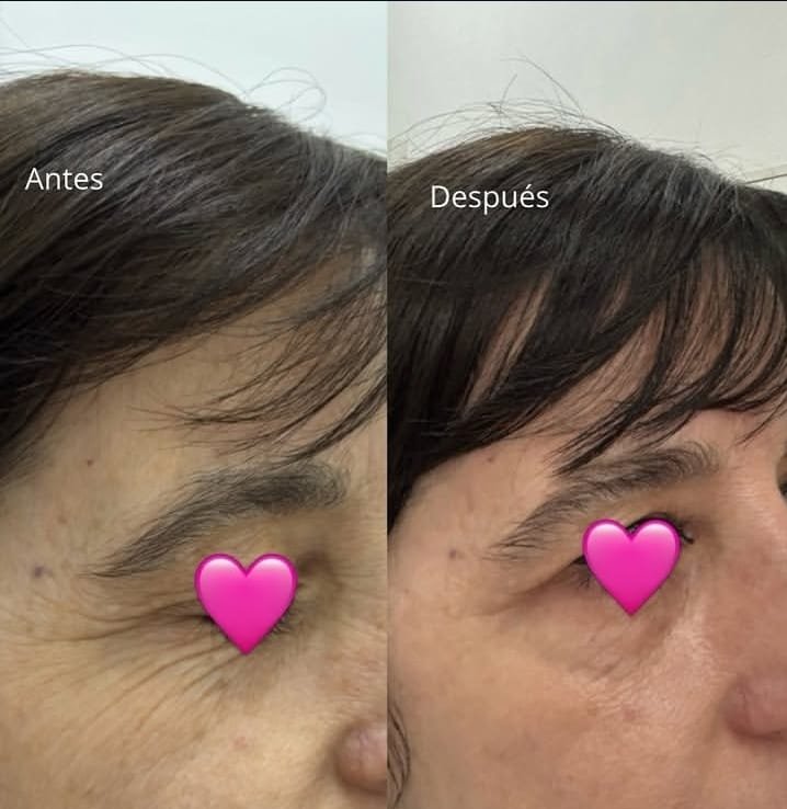 Antes y después de Plasma IQ en contorno de ojos