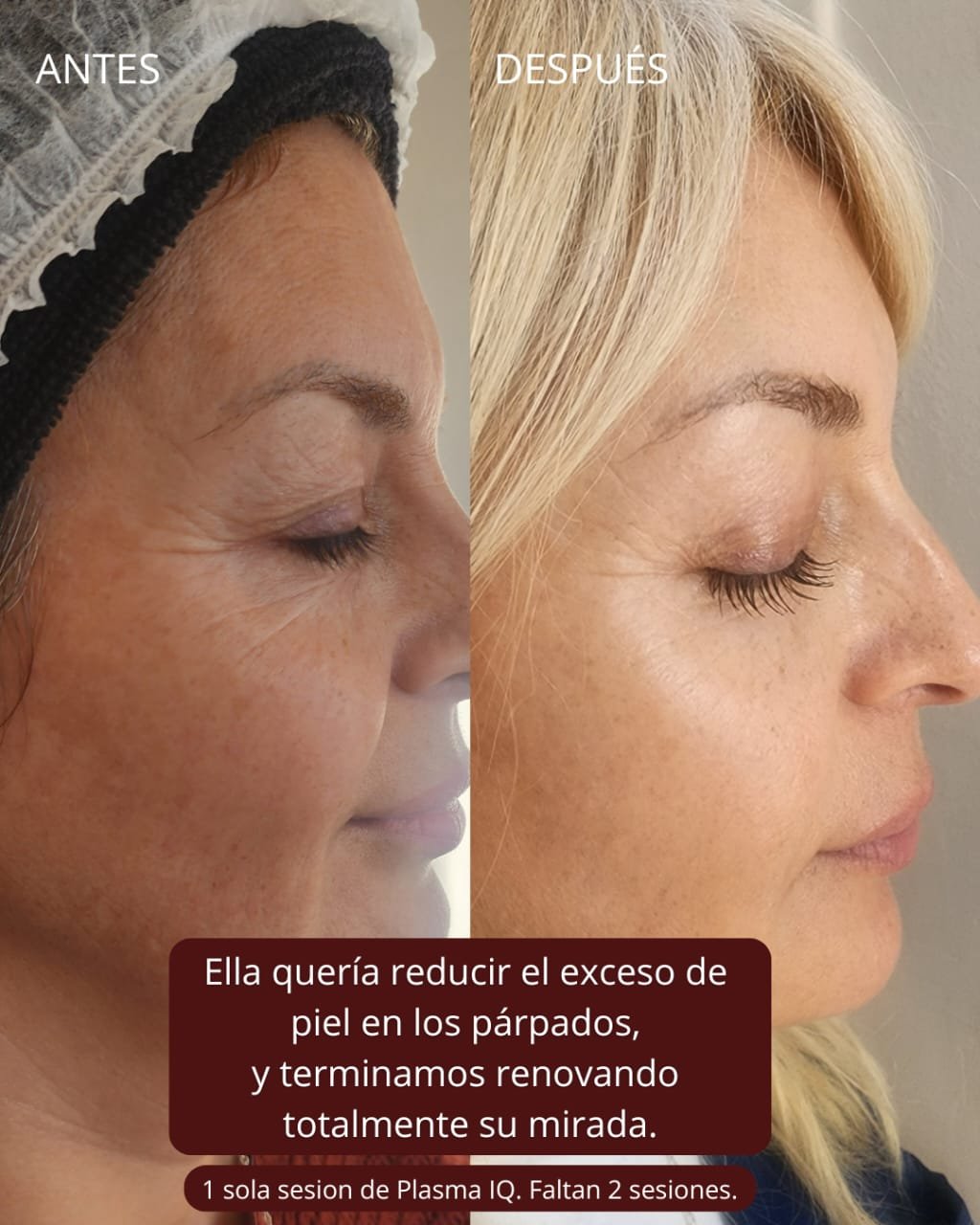 Antes y después de Plasma IQ